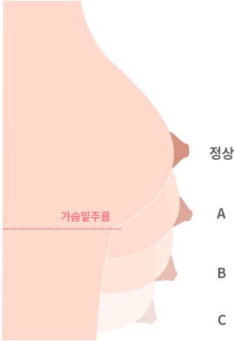 가슴 밑 주름 : 정상, A, B, C